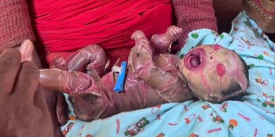 गुल्मीकी २७ वर्षीया गोमाले जन्माइन अनौठो शिशु